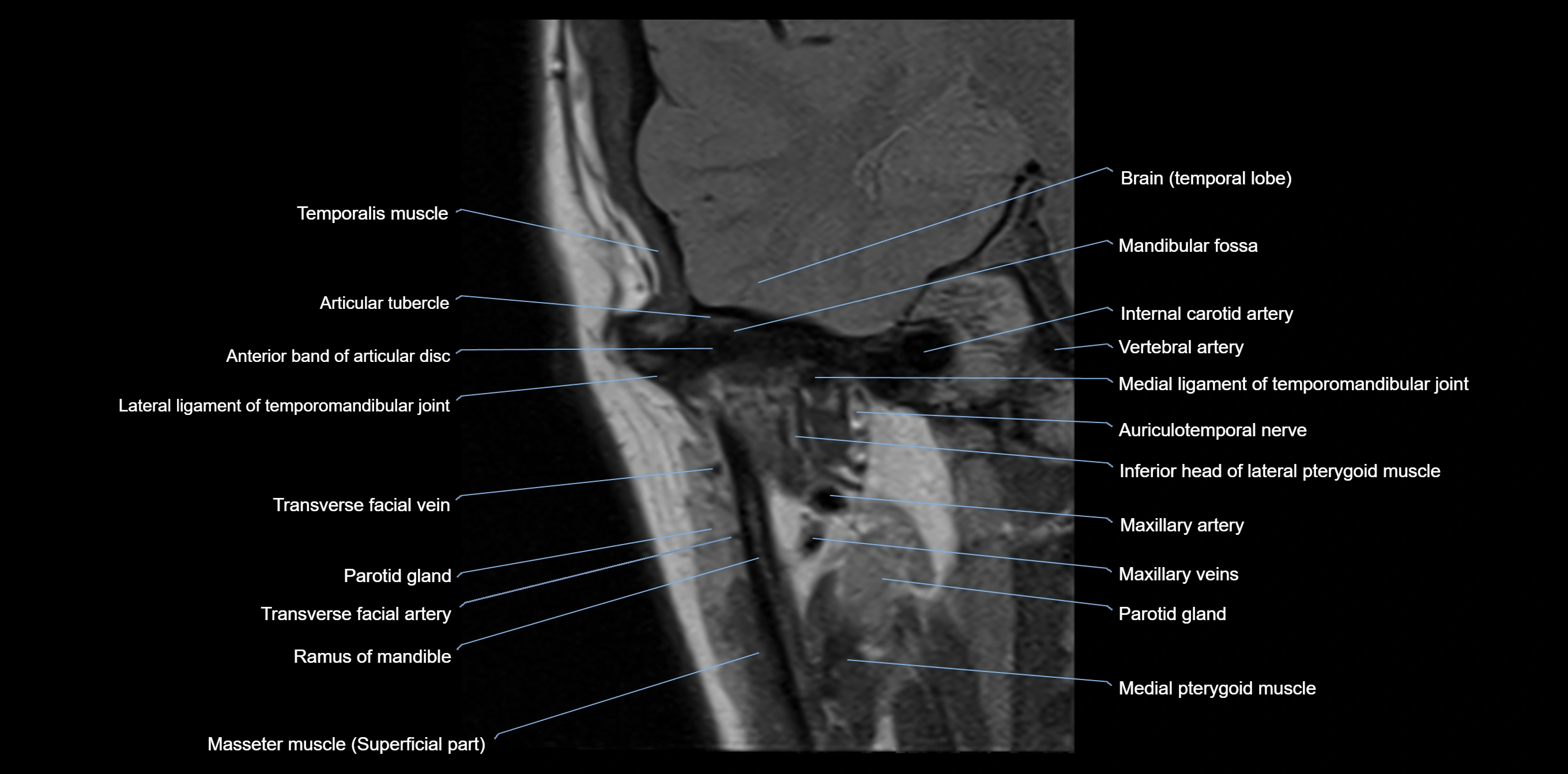MRI TMJ coronal cross sectional 3T anatomy -img-00004-00005.webp